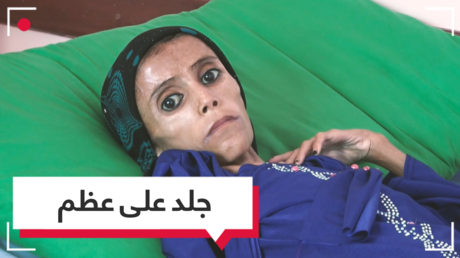 عجوز في عز طفولتها.. هذا ما يحدث للأطفال في اليمن بسبب الجوع !