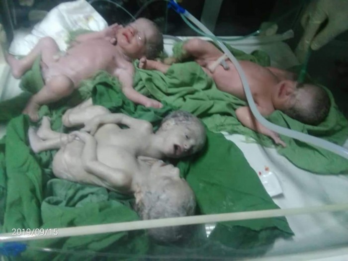 في حالة نادرة.. يمنية تلد 4 توأم منهم 2 سيامي في أحد مستشفيات العاصمة صنعاء ” صورة”