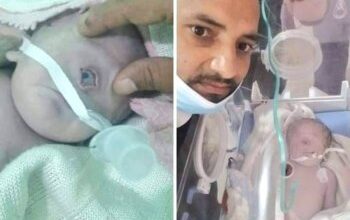 صورة اليمن تشهد حالة ولادة طفل بعين واحدة